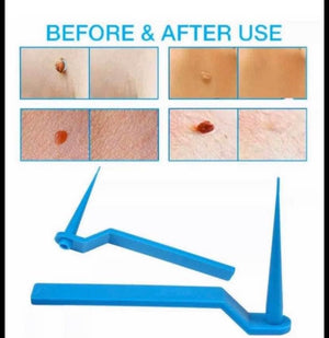 Micro Safe Skin Tag Remover Kit for Fast & Effective Skin Tag Removal